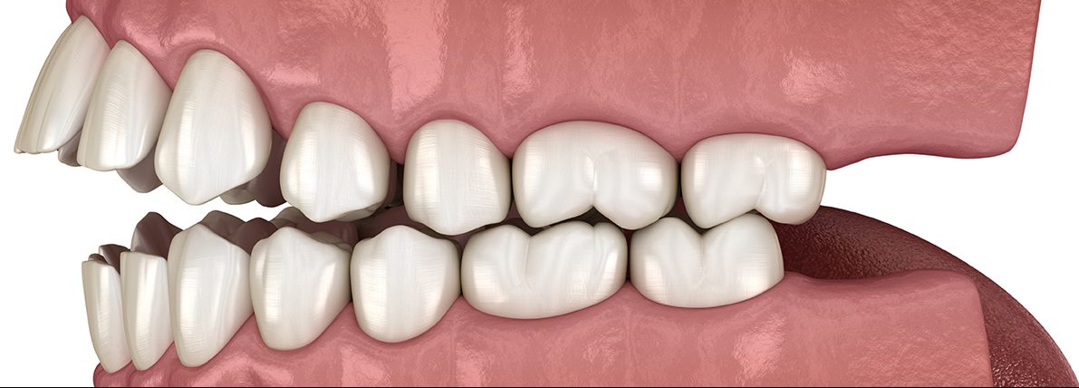 Composite dentaire : avantages et inconvénients